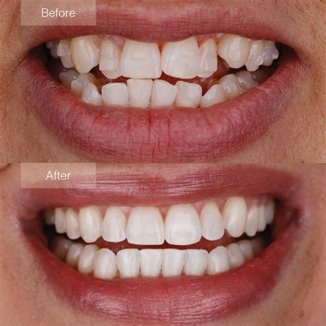invisalign malala|Invisalign before and after .